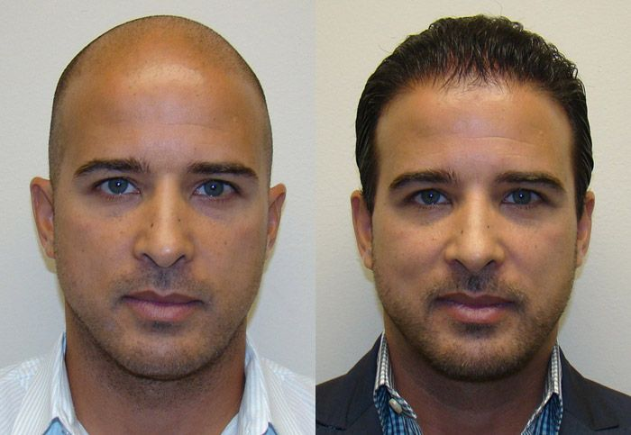 Antes y después — recuperación capilar con Excalvo
